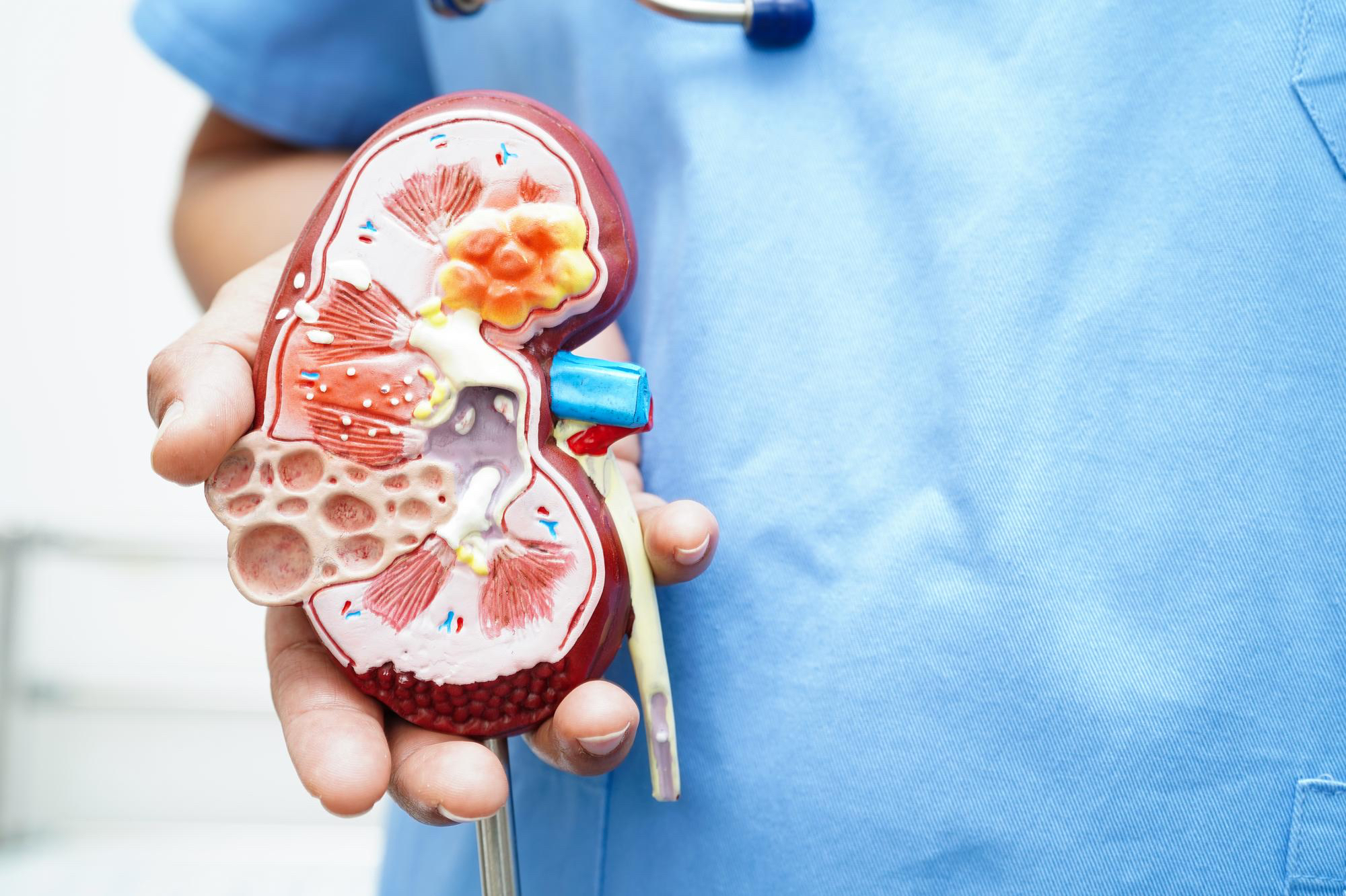 Your liver disease can affect you kidneys more than you think